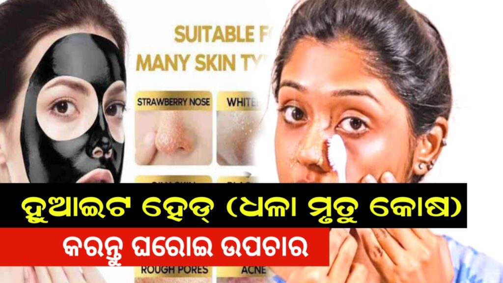white heads removal at home in odia health