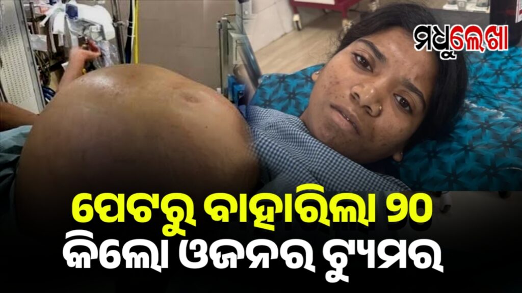 ନାବାଳିକାଙ୍କ ପେଟରୁ ବାହାରିଲା ୨୦ କେଜି ଓଜନର ଟ୍ୟୁମର